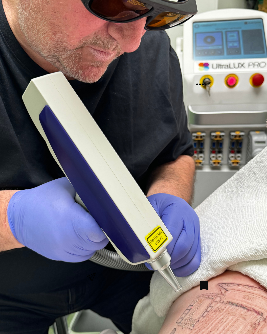 Laser tattoo removal treatment at Really Good Tattoo Removal in Sandgate